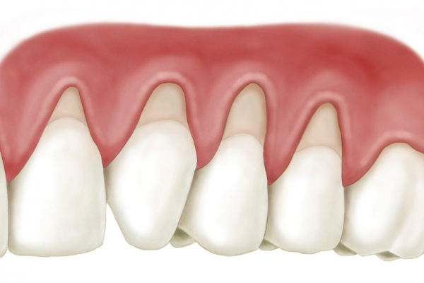 Có nguy cơ bị tụt lợi